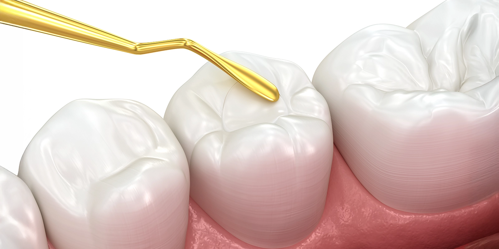 天然歯のような自然な美しさを実現する治療