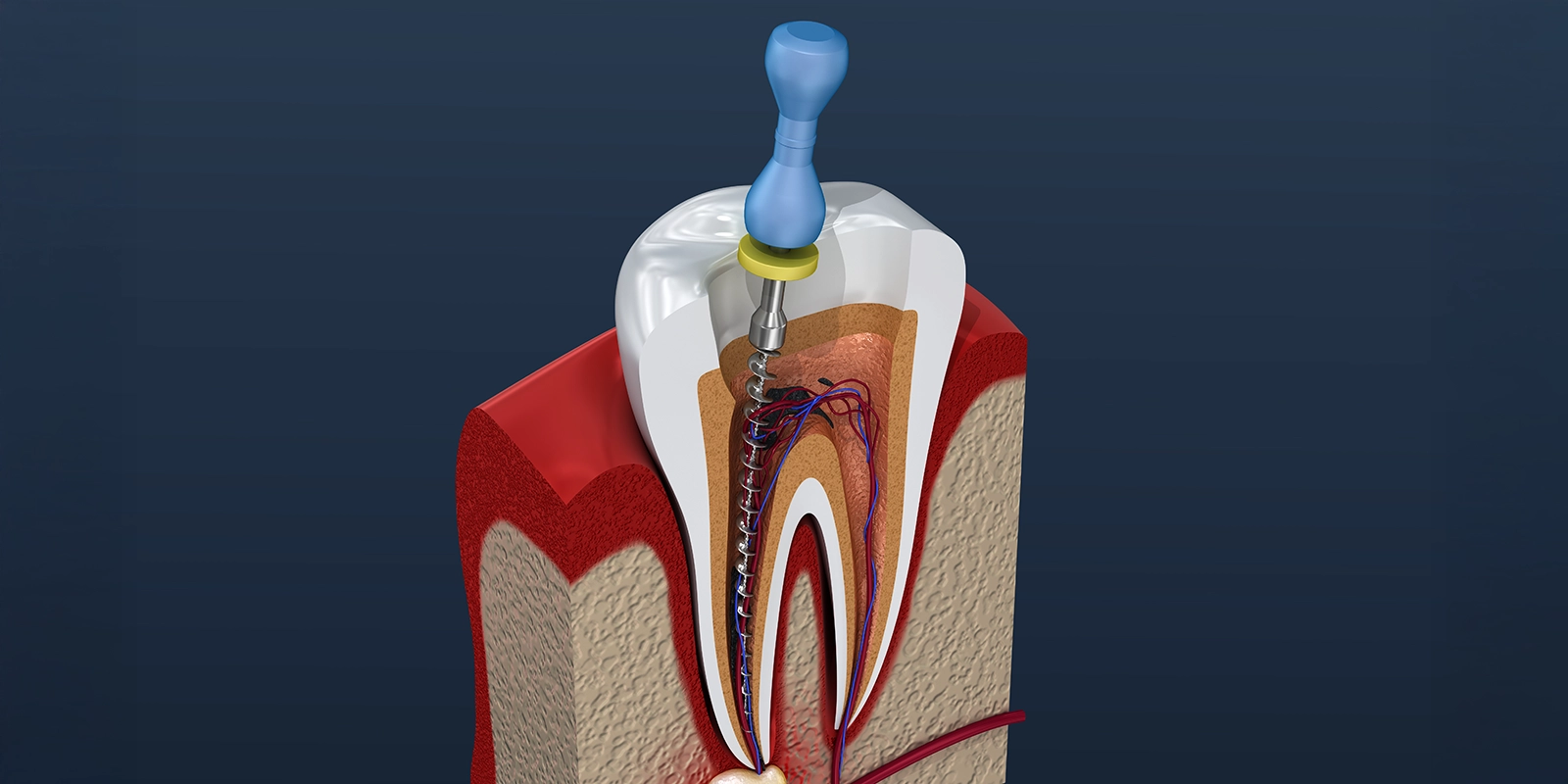 根管治療後の修復