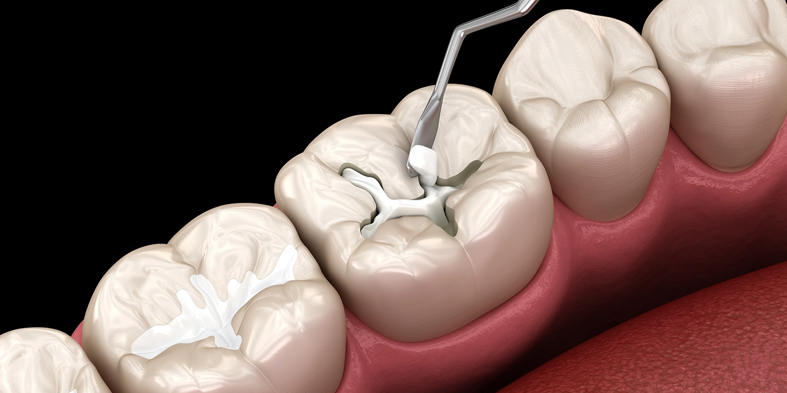 峯歯科高輪松ケ丘院のダイレクトボンディング
