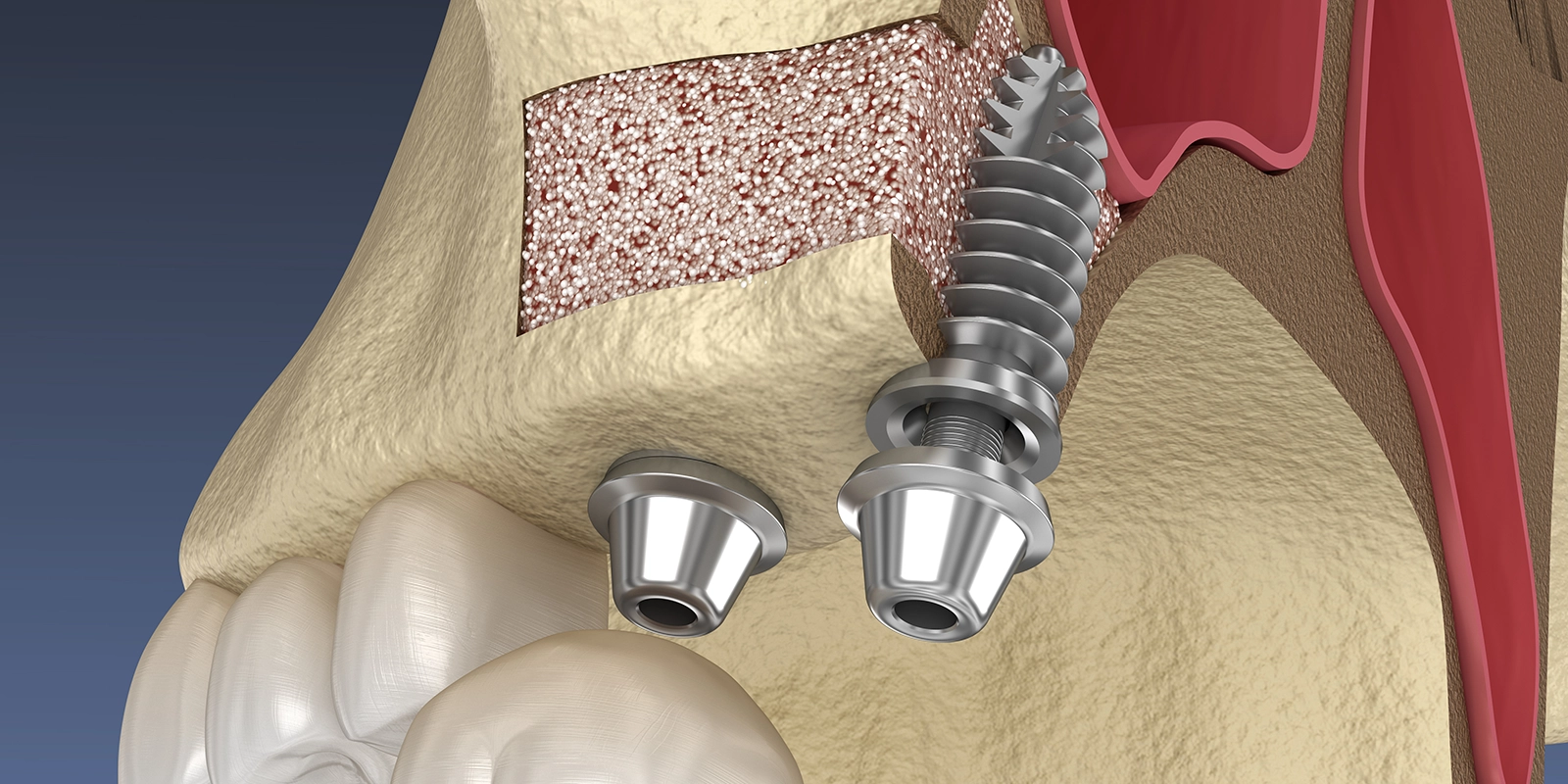 骨が少ないと一般的にインプラントはできない