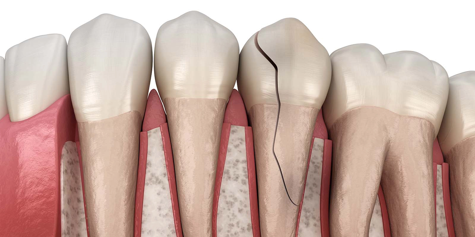 歯根破折について