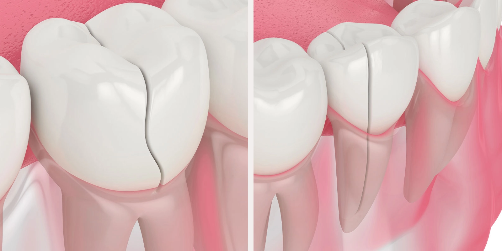 接着治療が可能な歯と不可能な歯