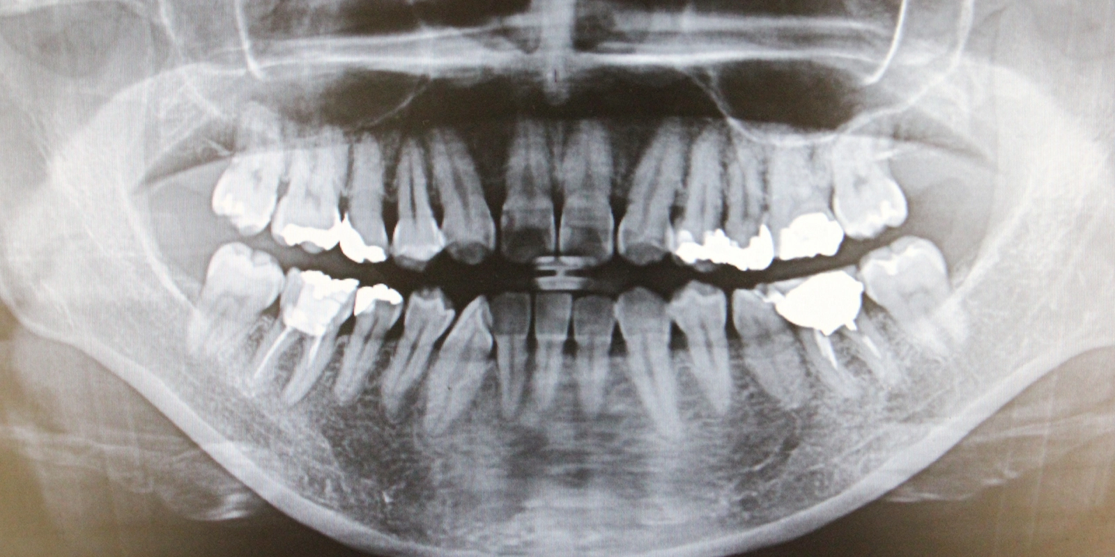 パノラマレントゲンの活用