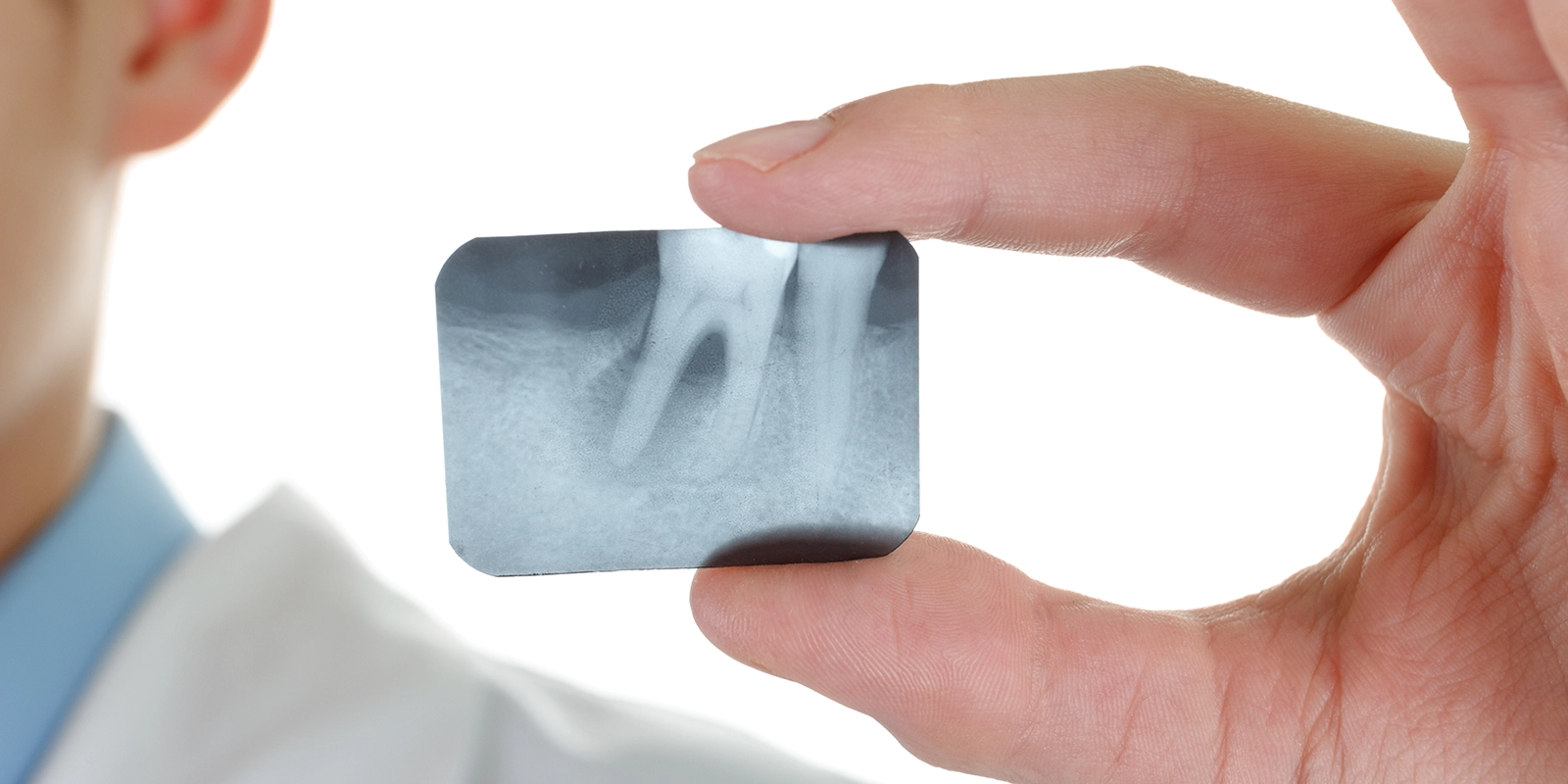 デンタルレントゲンの役割