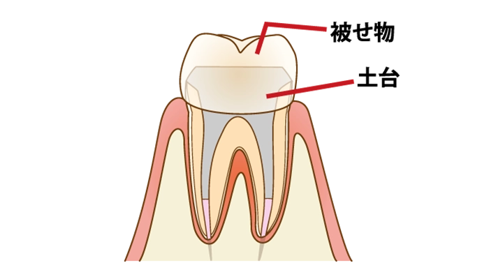 神経をとった歯、差し歯が入った歯