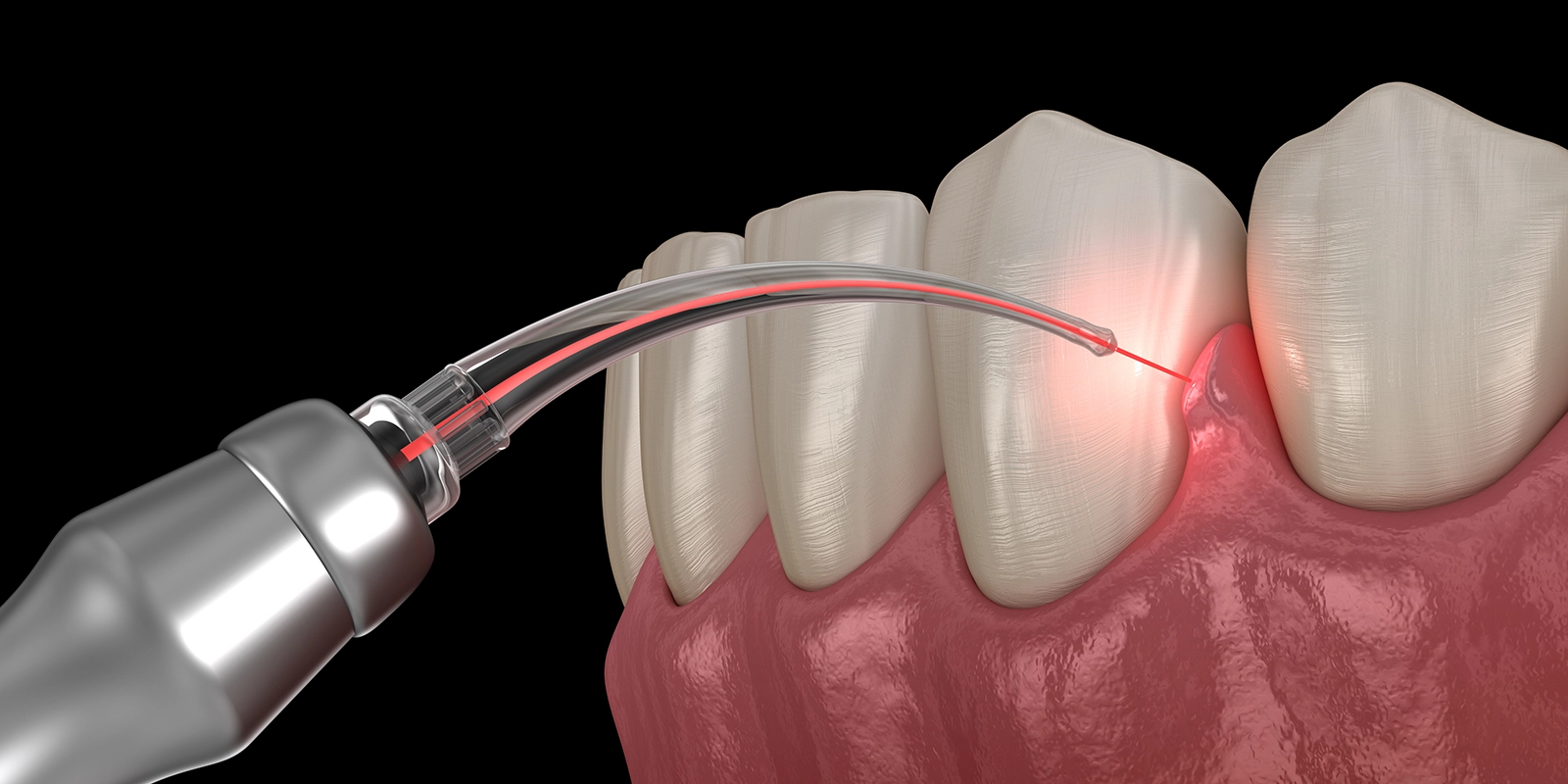 レーザー治療の最大の特徴：低侵襲性