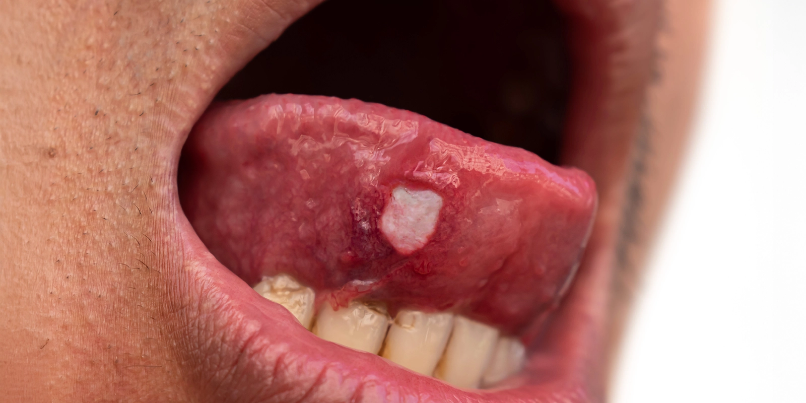 腫瘍の除去も低侵襲で